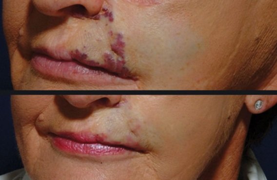 Distill Laser Clinic